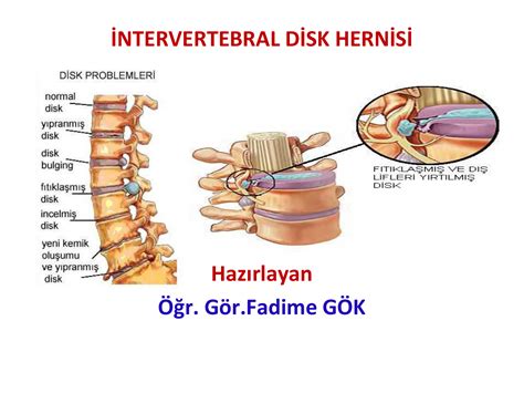 servikal intervertebral disklerde dejenerasyon nedir